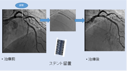 冠動脈カテーテル治療 PCI