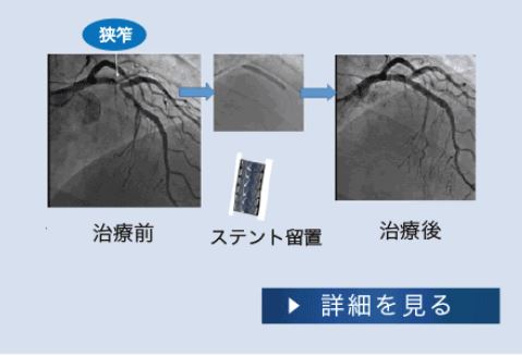 PCI・冠動脈カテーテル治療について